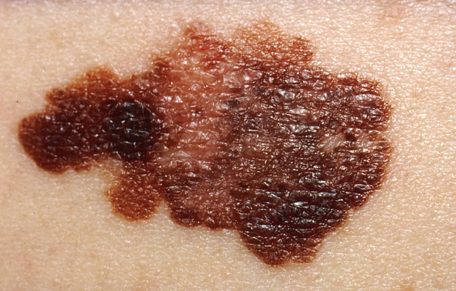 skin cancer and